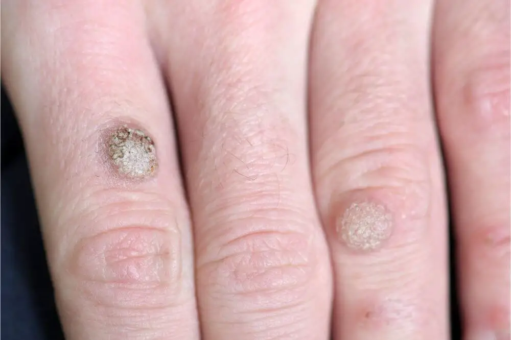 Can You Burn Off a Wart with a Soldering Iron